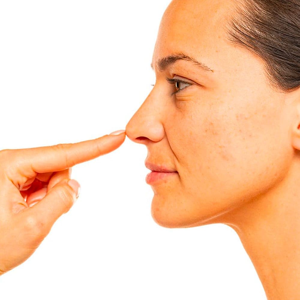 rhinoplastie de pointe globuleuse nez bulbeux nez rond rhinoplastie pointe tombante chirurgie du nez operation esthetique du nez rhinoplastie chirurgien esthetique paris docteur frederic picard